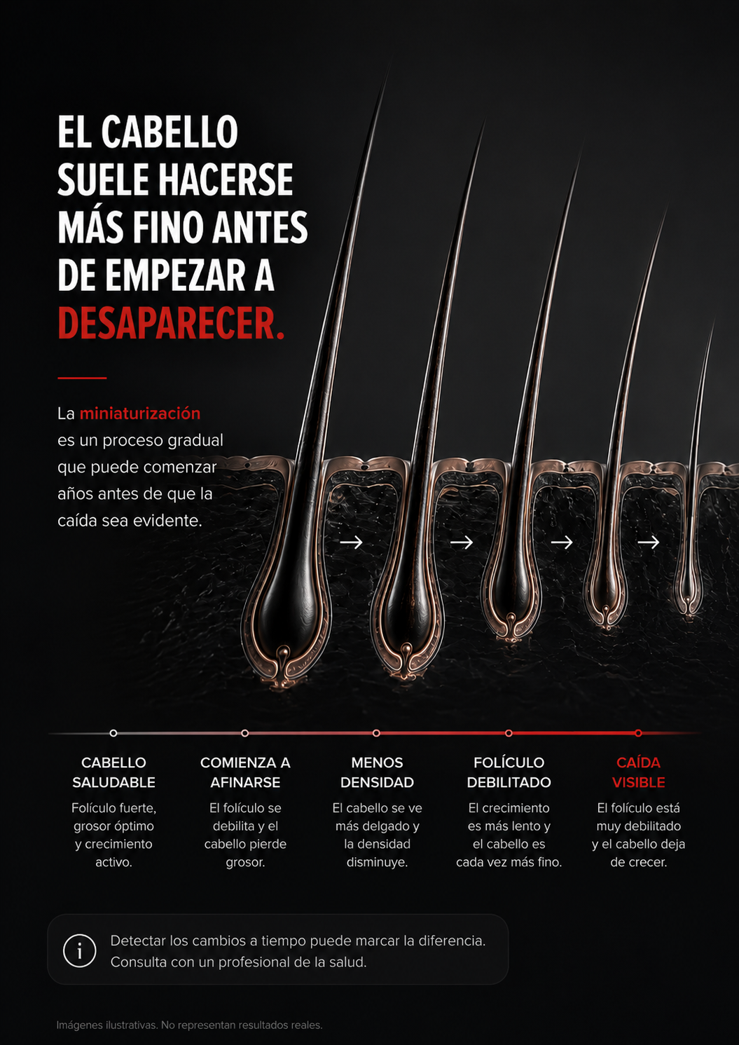 Ilustración educativa de la miniaturización del folículo en la alopecia androgenética